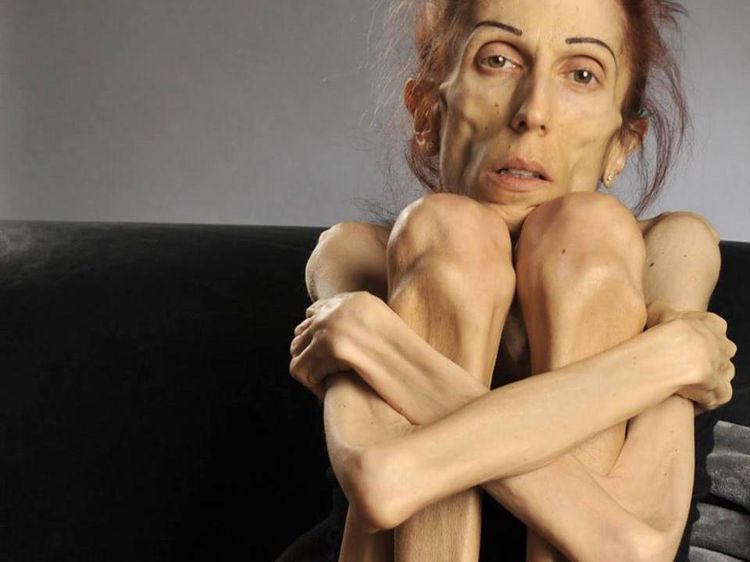 Potret Rachael Farrokh Lawan Anoreksia yang Bikin Bobotnya Hanya 18 Kg