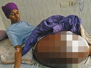 Terpaksa Diamputasi, Pria dengan 55 Kg Tumor di Kaki Akhirnya Bisa Berjalan