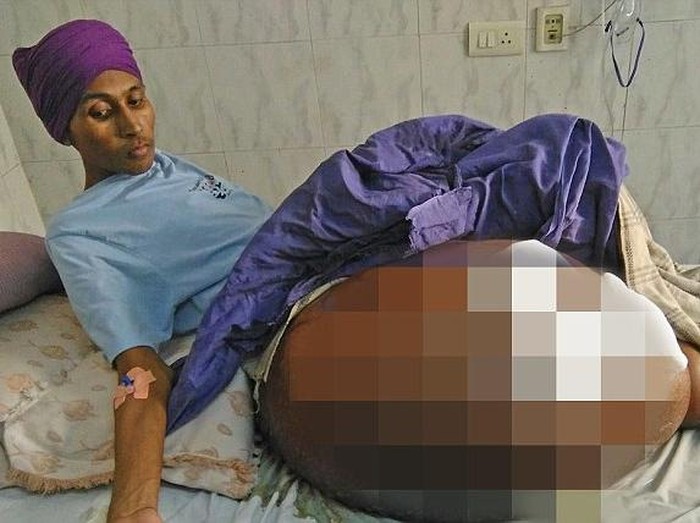 Terpaksa Diamputasi, Pria dengan 55 Kg Tumor di Kaki Akhirnya Bisa Berjalan