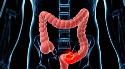 Fakta-fakta Gastroenteritis, Penyakit yang Diidap Balita di Blitar