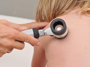 Begini Prosedur Laser untuk Hilangkan Tanda Lahir pada Anak