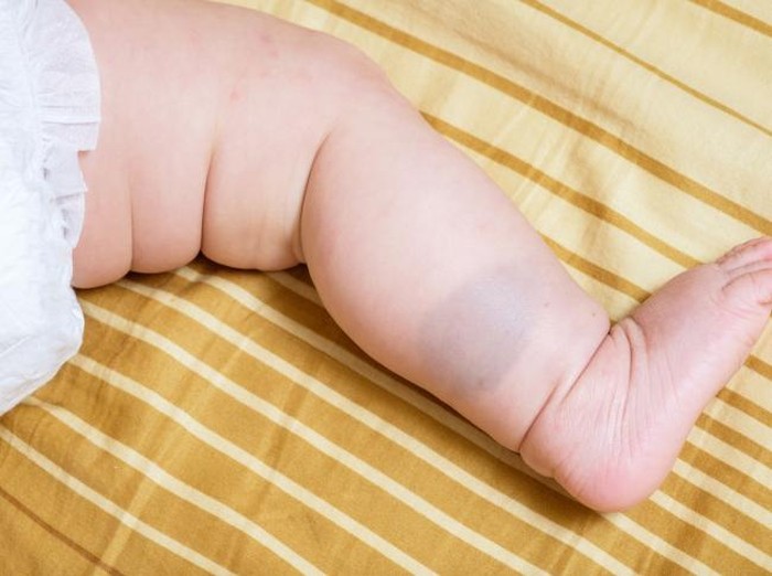 Ada Anak yang Punya Tanda Lahir dan Tidak, Mengapa?