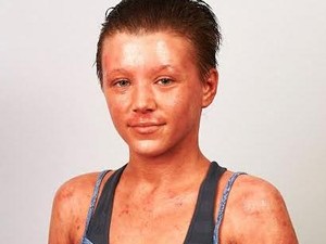 Pengobatan Eksim Malah Bikin Wanita Ini Merasa Seperti Lobster Rebus