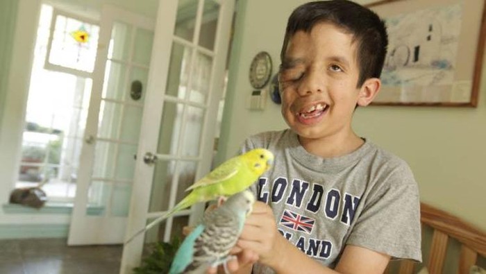 Bocah Ini Tolak Dioperasi Meski Separuh Wajah Tertutup Tumor
