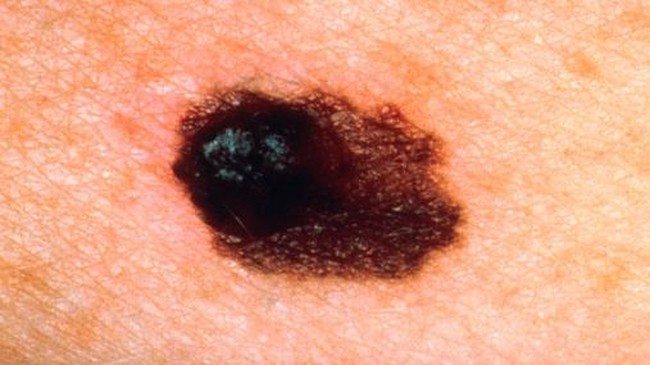 5 Tanda Kanker Kulit yang Kerap Terabaikan