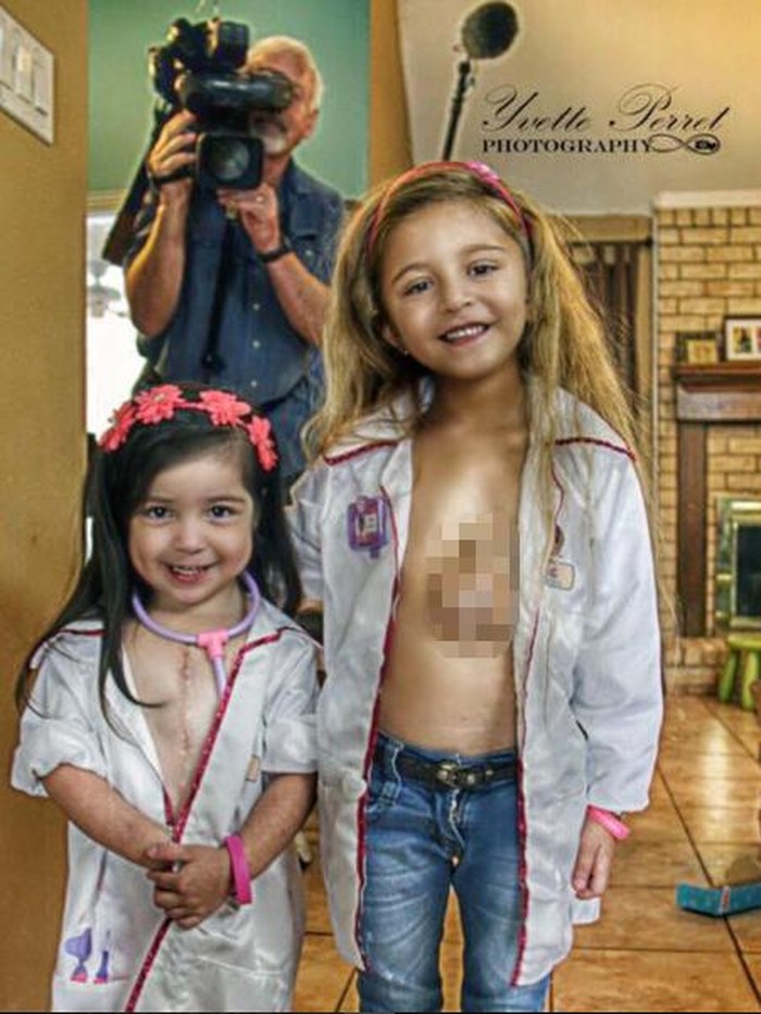 Ketika 2 Gadis Cilik dengan Jantung di Luar Tubuh Bermain Bersama