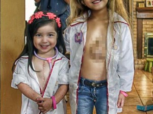 Ketika 2 Gadis Cilik dengan Jantung di Luar Tubuh Bermain Bersama