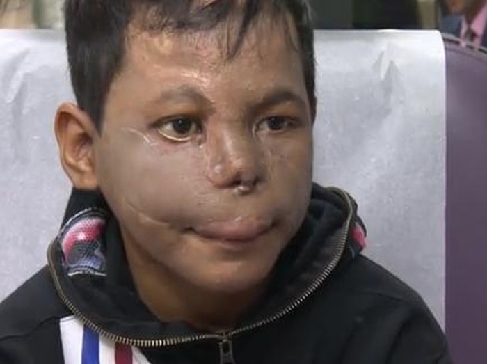 Bocah 9 Tahun Ini Punya Hidung Lagi Berkat Printer 3D