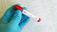 Mirip Flu Biasa, Waspadai Ciri HIV dan Cara Penularannya