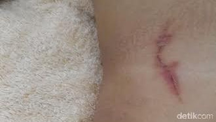 Kondisi dermatitis venenata