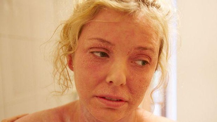 Berhenti Pakai Obat Pereda Eksim, Kulit Wanita Ini Malah Rontok