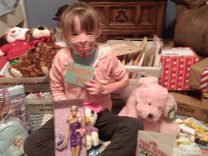 Kisah Safyre, Bocah yang Alami Luka Bakar Parah