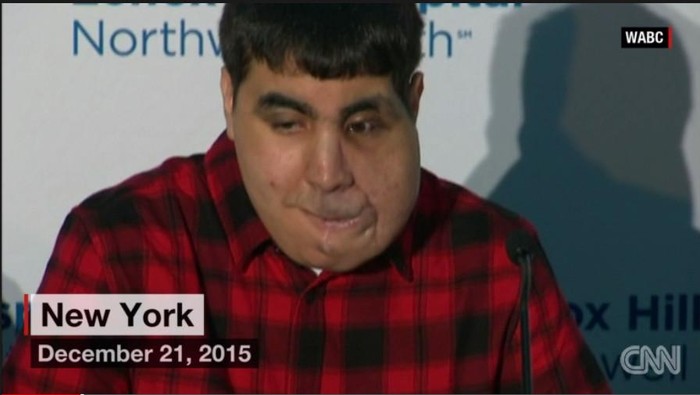 Pipi yang Bengkak dan Melorot Selesai Dioperasi, Remaja Ini Siap Sekolah Lagi