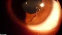 Dalam sebuah video yang diunggah ke LiveLeak, beredar penampakan seorang perempuan yang sedang diperiksa matanya. Dalam video terlihat jelas bahwa ada seekor cacing yang diduga merupakan jenis cacing gelang. (Foto: LiveLeak)