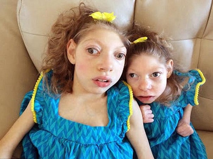 Lola dan Claire, Kakak Beradik dengan Berat Total Hanya 19 Kg