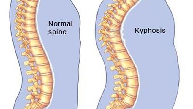 Tiga Ragam Kelainan Tulang Belakang