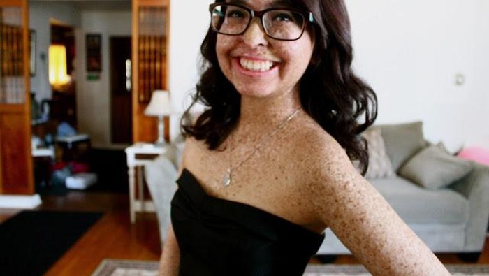 Kulit Penuh Bintik-bintik dan Idap Alergi Matahari, Wanita Ini Tetap Pede