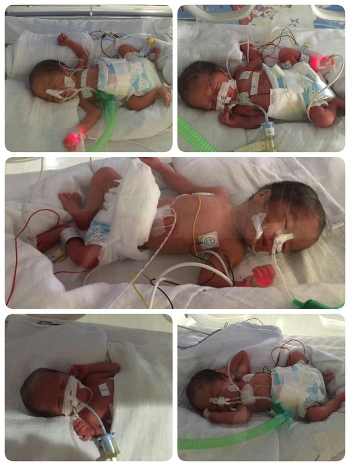 Bayi Kembar Lima dari Cirebon Sudah Lepas Alat Bantu