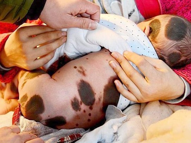 4 Kasus Giant Congenital Nevus dari Berbagai Belahan Dunia
