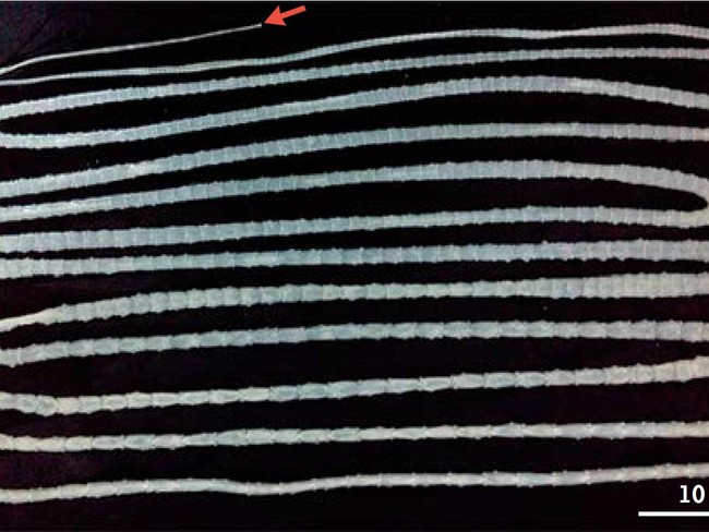 5 Tanda Kamu Mungkin Punya Cacing Parasit di Perut