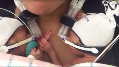 Kristiana dan Kristian, bayi kembar prematur yang bergandengan tangan selepas lahir