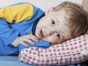 Waspada, 4 Penyakit Anak-anak yang Masih Bisa Terjangkit di Usia Dewasa