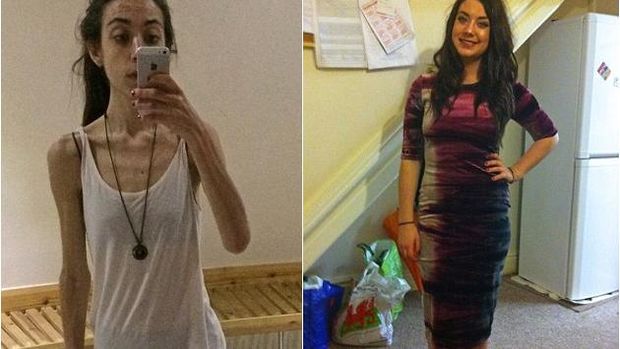 Astaga Bobot Turun Jadi 37 Kg Gara Gara Terobsesi Paha Ramping