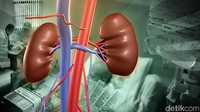 Ada dua cara untuk mengatasi Lupus Nephritis. Pertama adalah cuci darah atau dialisa, yakni mengeluarkan darah untuk dipisahkan dari racun dengan menggunakan mesin khusus. Foto: Ilustrasi oleh Basith Subastian