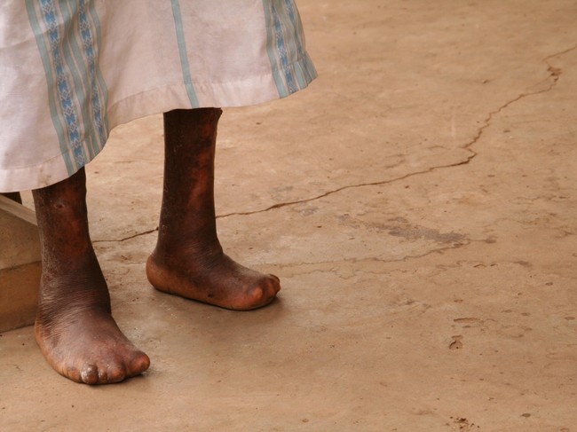 4 Tantangan Eliminasi Penyakit Kusta di Indonesia