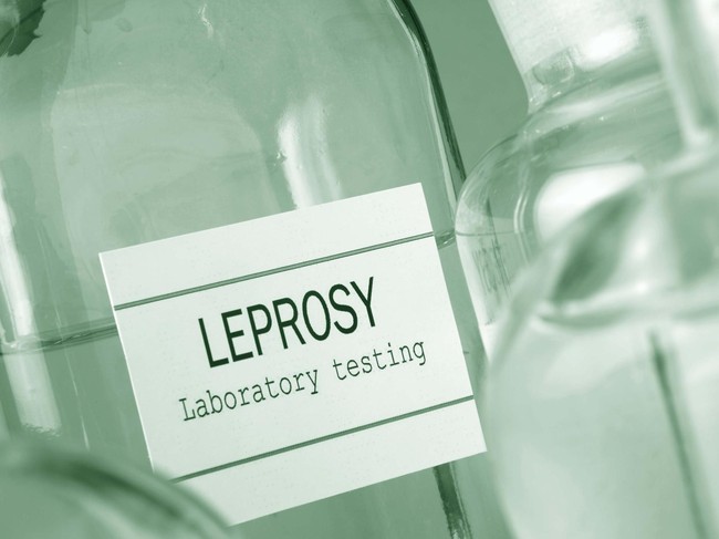 Fakta-fakta Soal Kusta yang Wajib Anda Ketahui