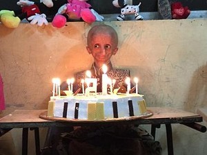 Nihal, Remaja 15 Tahun yang Tubuhnya Seperti Kakek-kakek Akibat Progeria