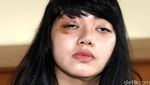 Begini Kondisi Dita yang Ngaku Dianiaya Masinton