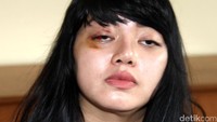 Hari ini terlihat Dita belum bisa membuka matanya secara sempurna. Pada Jumat pekan lalu, Dita melaporkan Masinton ke Badan Reserse dan Kriminal Mabes Polri.