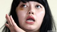 Dita dikabarkan mengadu ke LBK atas penganiayaan yang dilakukan Masinton.