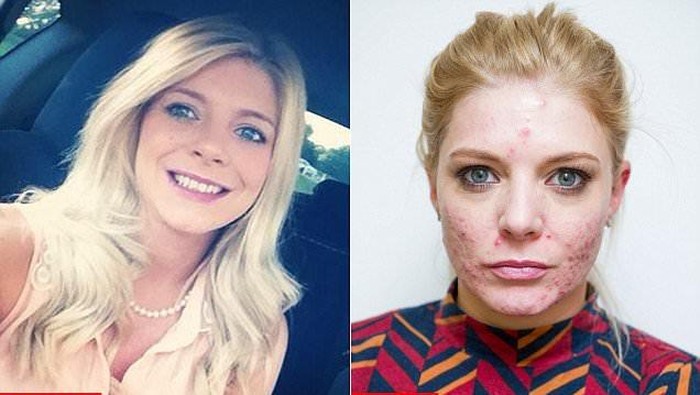 Alergi Parah, Kulit Wajah Wanita Ini Dipenuhi Bekas Luka dan Jerawat