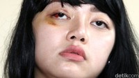 Tampak pelipis mata Dita berwarna kecokelatan bekas terkena pukulan. Kelopak mata Dita juga masih terlihat berwarna merah.