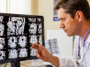 Gejala Glioblastoma, Tumor Otak Ganas yang Diidap 115 Alumni SMA di AS