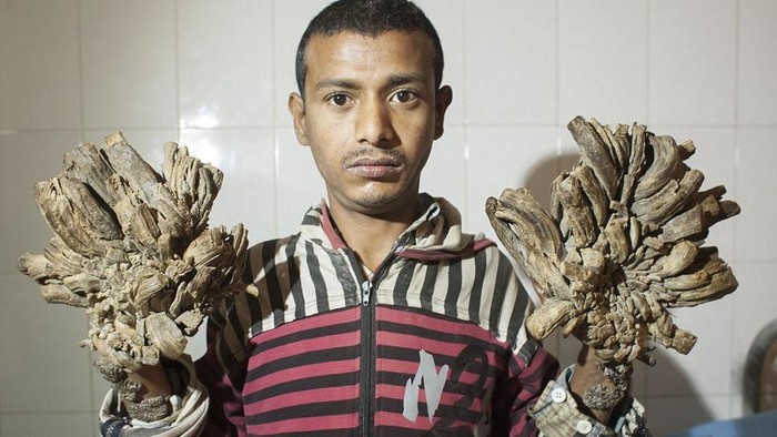 Karena Sakit Langka, Jari-jari Tangan dan Kaki Pria Ini Ditumbuhi Akar