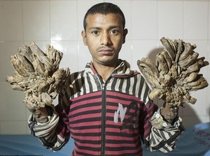 Karena Sakit Langka, Jari-jari Tangan dan Kaki Pria Ini Ditumbuhi Akar