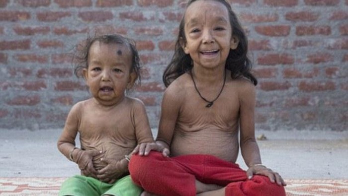 Kisah Kakak Beradik Usia 7 Tahun dan 18 Bulan yang Tampak Seperti Lansia