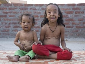 Kisah Kakak Beradik Usia 7 Tahun dan 18 Bulan yang Tampak Seperti Lansia