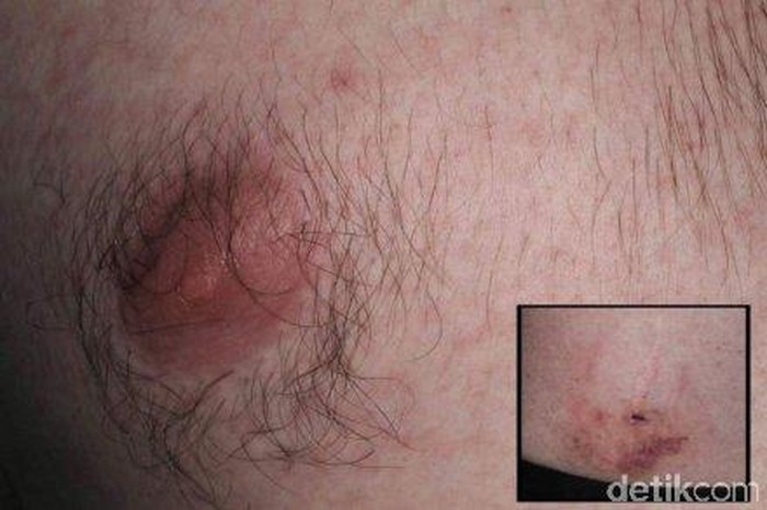 Pria Darwin Ini Pernah Didiagnosa Virus Zika Setelah Digigit Monyet di Bali