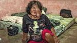 Menyedihkan! Potret Orang-orang dengan Tumor di Wajah Akibat Penyakit Langka