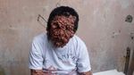 Menyedihkan! Potret Orang-orang dengan Tumor di Wajah Akibat Penyakit Langka
