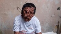 Urip, pria berusia 50 tahunan asal Tangerang, menjadi perhatian karena seluruh tubuhnya tertutup benjolan. Urip sehari-harinya menjual bensin dan membantu mengatur lalu lintas.