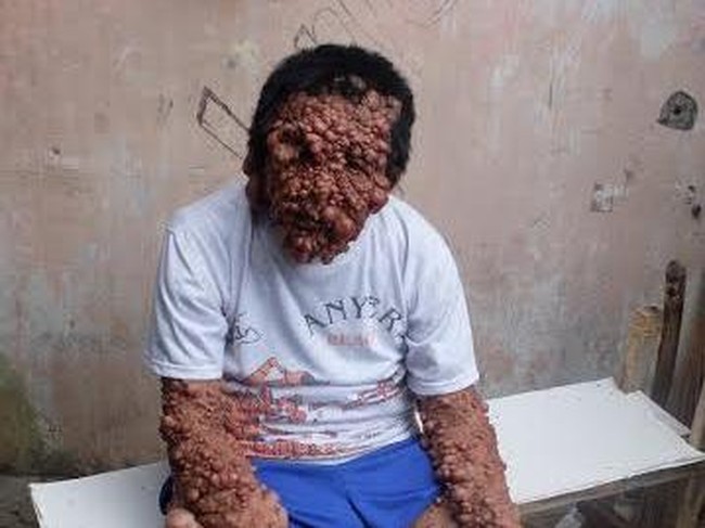 Selain Urip, Ini Orang-orang yang Hidup dengan Neurofibromatosis