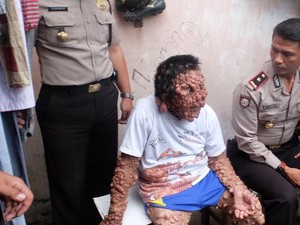 Sesuai UUD 1945, Pemerintah Harus Bantu Urip Sembuhkan Benjolan di Kulitnya