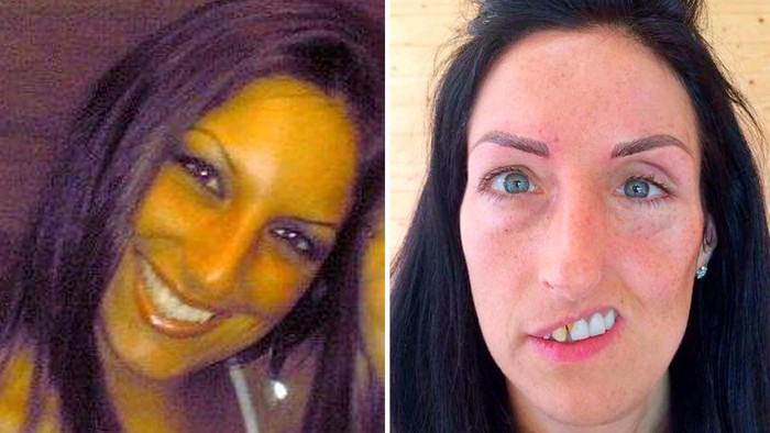 Wanita Ini Cari Pengobatan untuk Kembalikan Wajahnya yang Runtuh Separuh