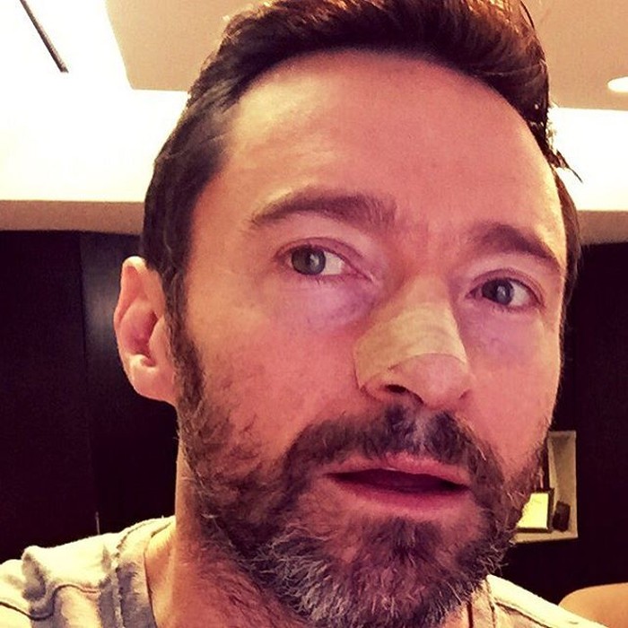 Kena Kanker Kulit, Ini Pesan Aktor Hugh Jackman