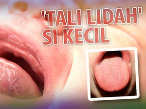 Bayi Juga Berisiko Mengalami Lip Tie Lho, Apa Itu?